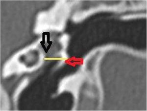 Middle ear depth measurement. Vertical section in the plane of the canal. The yellow line shows the depth of the middle ear. Red arrow: lateral process of the malleus; black arrow: medial wall of the middle ear.