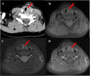 Subglottic masses in the 2-year-old boy presenting with stridor. Computed Tomography (CT) and Magnetic Resonance Imaging (MRI) scan of the neck showed (A) an abnormal soft-tissue density shadow on the medial side of bilateral thyroid upper pole with corresponding slightly narrowed airway (arrow). The thymus shadow was larger and seemed to extend to the neck. Transverse view of T1-weighted and Iterative Decomposition of water and fat with Echo Asymmetric and Least-squares estimation (IDEAL) T2-weighted MRI showed (B) isointense T1 and (C) hyperintense T2 masses in left of the trachea at the level of the thyroid gland and at the edge of the left and right lobe of the thyroid gland. (D) The masses enhanced slightly in contrast-T1-weighted transverse view. The trachea (arrow) was locally narrowed at the level of the thyroid gland.