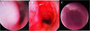 Direct Laryngoscopy and Bronchoscopy (DLB) showed (A) a subglottic semicircular mass with smooth mucosa, obstructed 70% laryngeal cavity (pre-operation). (B) Subglottic obstruction was significantly relieved (immediate post-operation). (C) Laryngeal obstruction was significantly relieved (a week after surgery).
