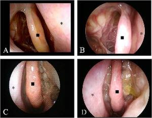 Serial endoscopic records of the nasal cavity in typical cases. Well controlled case: (A) 3-months after surgery, right Escore is 4 (bilateral 7); (B) After 5-years, right Escore is 3 (bilateral 6). Uncontrolled case: (C) 3-months after surgery, right Escore is 8 (bilateral 16); (B) After 4-years, right Escore is 10 (bilateral 21). (◼; middle turbinate, *; nasal septum).