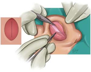 Distal and proximal based fasciaperichondrial flap illusturation.
