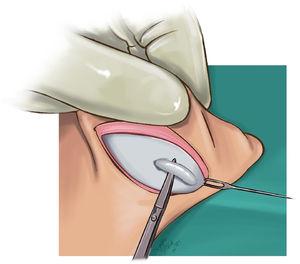 Conchal cartilage excision illusturation.