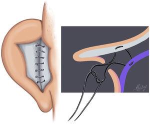 Concha-mastoid (Furnas) sutures demonstration illustration.
