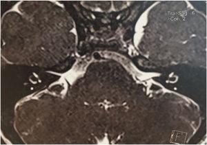Magnetic resonance imaging (T2-weighted image). Axial plane. Patient with bilateral sensorineural hearing loss. Evidence of eighth nerve aplasia in the right ear.