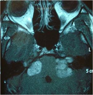 Magnetic resonance imaging (contrast-enhanced T1-weighted image). Axial plane. Presence of bilateral vestibular schwannoma (neurofibromatosis type 2).