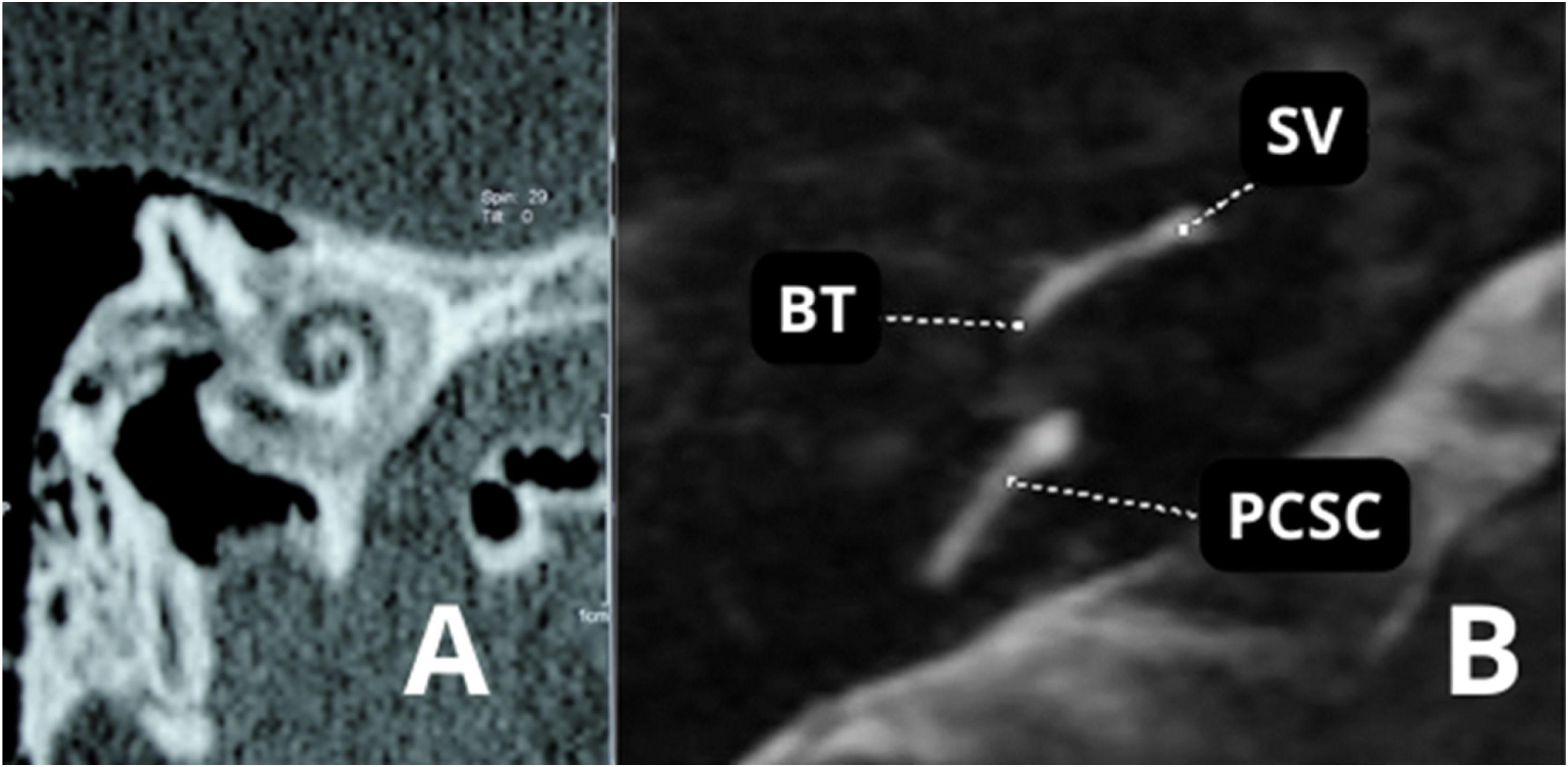 Otosclerosis, Otolaryngology⁠ — Head & Neck Surgery