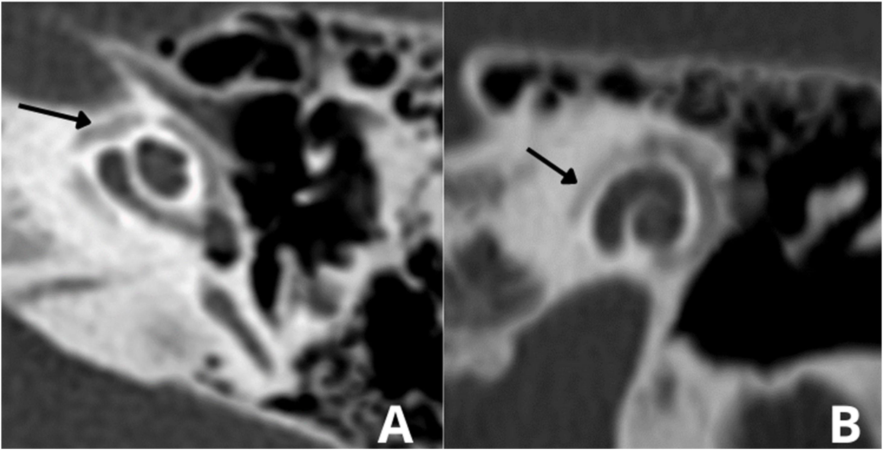 X-Linked Stapes Gusher: CT Findings in One Patient