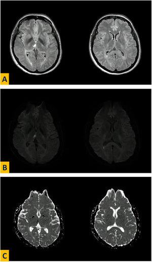 Resonancia cerebral magnética, corte axial en secuencia FLAIR (A), DWI (B) y mapa de ADC (C) que muestra infarto isquémico talámico medial derecho y de la pared posterior del atrio ventricular ipsolateral.