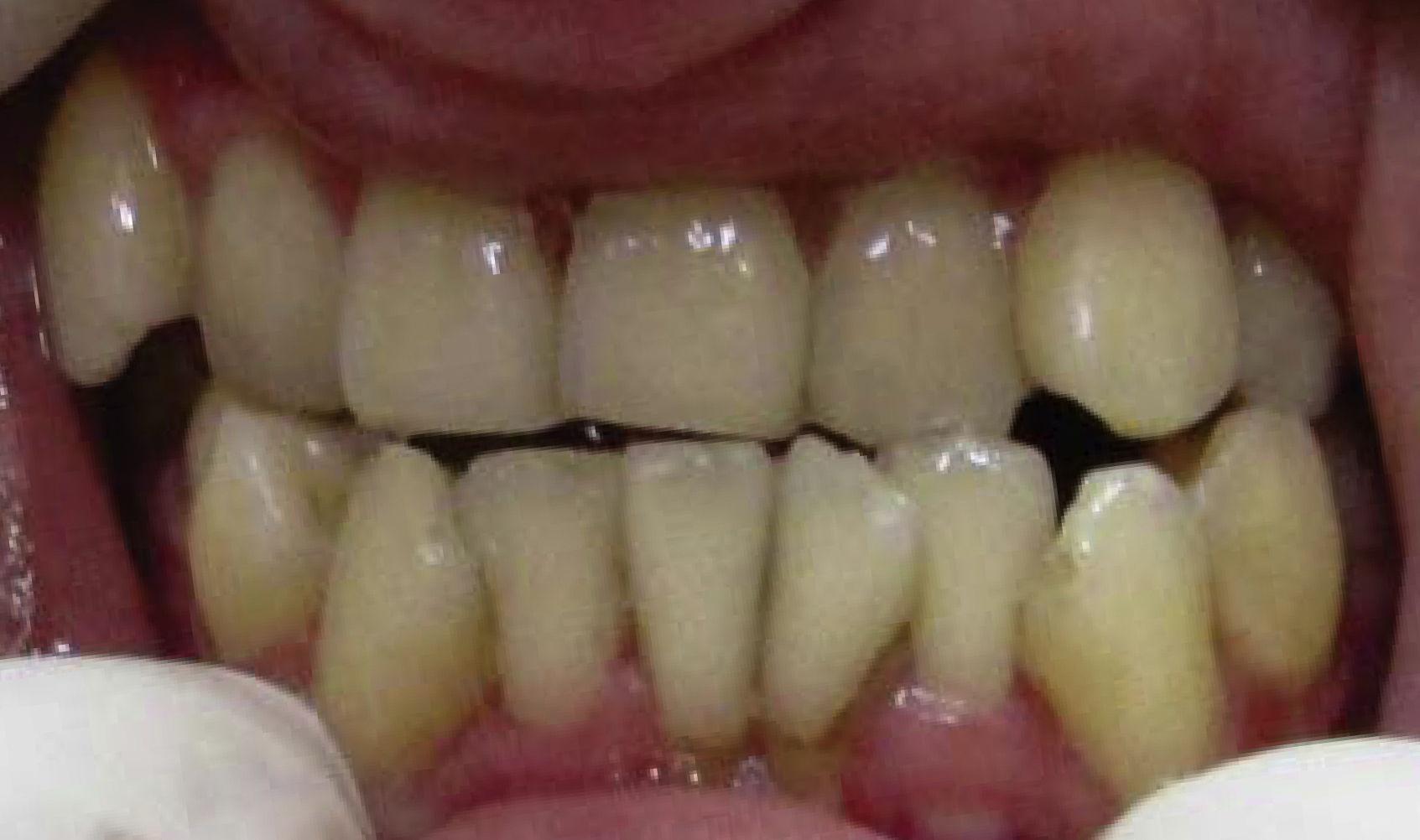 JCDR - Rubinstein Taybi Syndrome, Oro-facio-dental findings