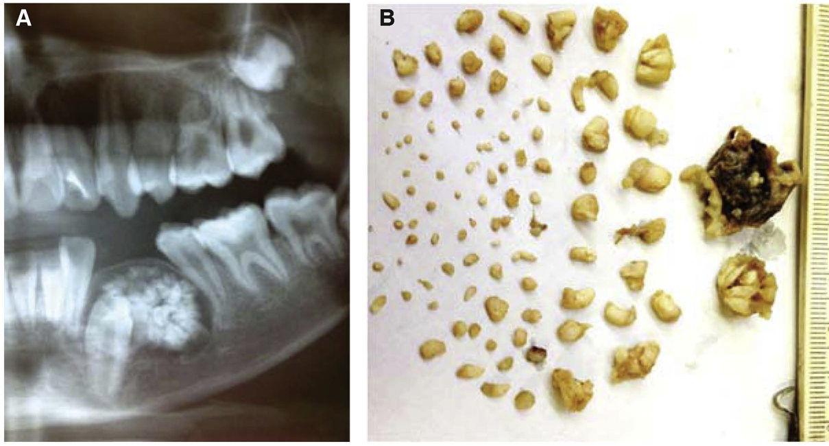 PDF] Peripheral Tumor with Osteodentin and Cementum-like Material in an  Infant: Odontogenic Hamartoma or Odontoma?