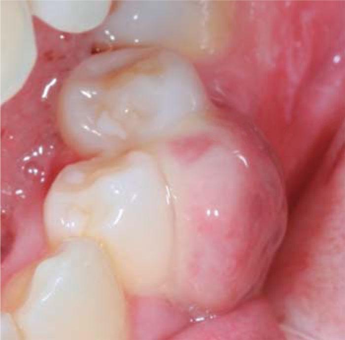 granulation tissue mouth