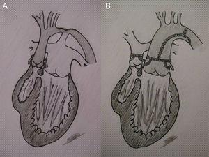 A: left ventricle connected to the pulmonary artery (high flow) and right ventricle (rudimentary) connected to the aorta (single-ventricle physiology with transposition of the great arteries); restrictive ventricular septal defect (subaortic stenosis) and aortic coarctation. B: repaired arch plus palliative switch, connecting the left ventricle with the neoaorta and creating subpulmonary stenosis (pulmonary flow regulated by the restrictive ventricular septal defect).