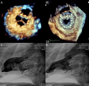 Three-dimensional echocardiography image of the Tiara valve in an animal model, with ventricular (A) and atrial (B) views and left ventricular angiography in diastole (C) and systole (D). Reproduced with permission from Banai et al.60