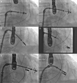 Fluoroscopy sequence of MitraClip device implantation A: advanced to the mitral orifice. B: opening of the arms in the left ventricle chamber. C: withdrawal and closure of the arms to grasp the 2 mitral leaflets. D: device release. E: advancement and opening of a second device. F: implantation of a second MitraClip device. Courtesy of Dr. Ted Feldman (Evanston Hospital, Evanston, Illinois, United States).