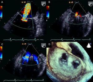 Transesophageal echocardiography images before and after MitraClip device implantation A: mitral regurgitation before implantation. B: mitral regurgitation after implantation. C and D: 2-dimensional and 3-dimensional transesophageal echocardiography images of a double orifice valve. Courtesy of Drs. Howard Herrmann and Frank E. Silvestry (Hospital of the University of Pennsylvania, Pennsylvania, United States).