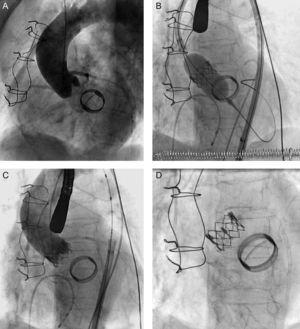 A: Preimplantation aortography. B: Valve deployment. C: Final aortography. D: Anatomic relationship between the prostheses.