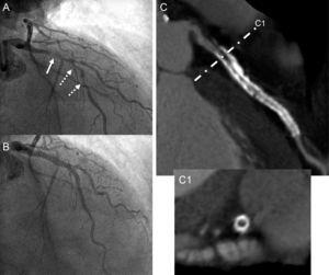 A: Intraluminal thrombus leading to deficient perfusion in the proximal segment of the left anterior descending artery (solid arrow) and severe atheromatous disease in the medial segment of the same artery (dashed arrows). B: Angiographic outcome at the site of primary angioplasty with placement of 2 overlapping drug-eluting metal stents. C: Noninvasive angiographic study by computed tomography at 2 years; a substantial metal artifact is observed (high white density) resulting from both stents. C1: Transversal section of the proximal segment of the left anterior descending artery showing significant intrastent neointimal hyperplasia in the study (low black density tissue).