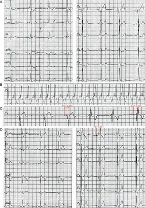 A: The admission ECG showed sinus rhythm. B: ECG during tachycardia. C: Holter ECG. D: The ECG recorded after the ablation.