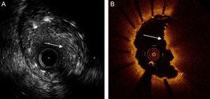 Intravascular ultrasound image (A) and optical coherence tomography image (B) of stent thrombosis, with a substantial intraluminal thrombus attached (arrow).