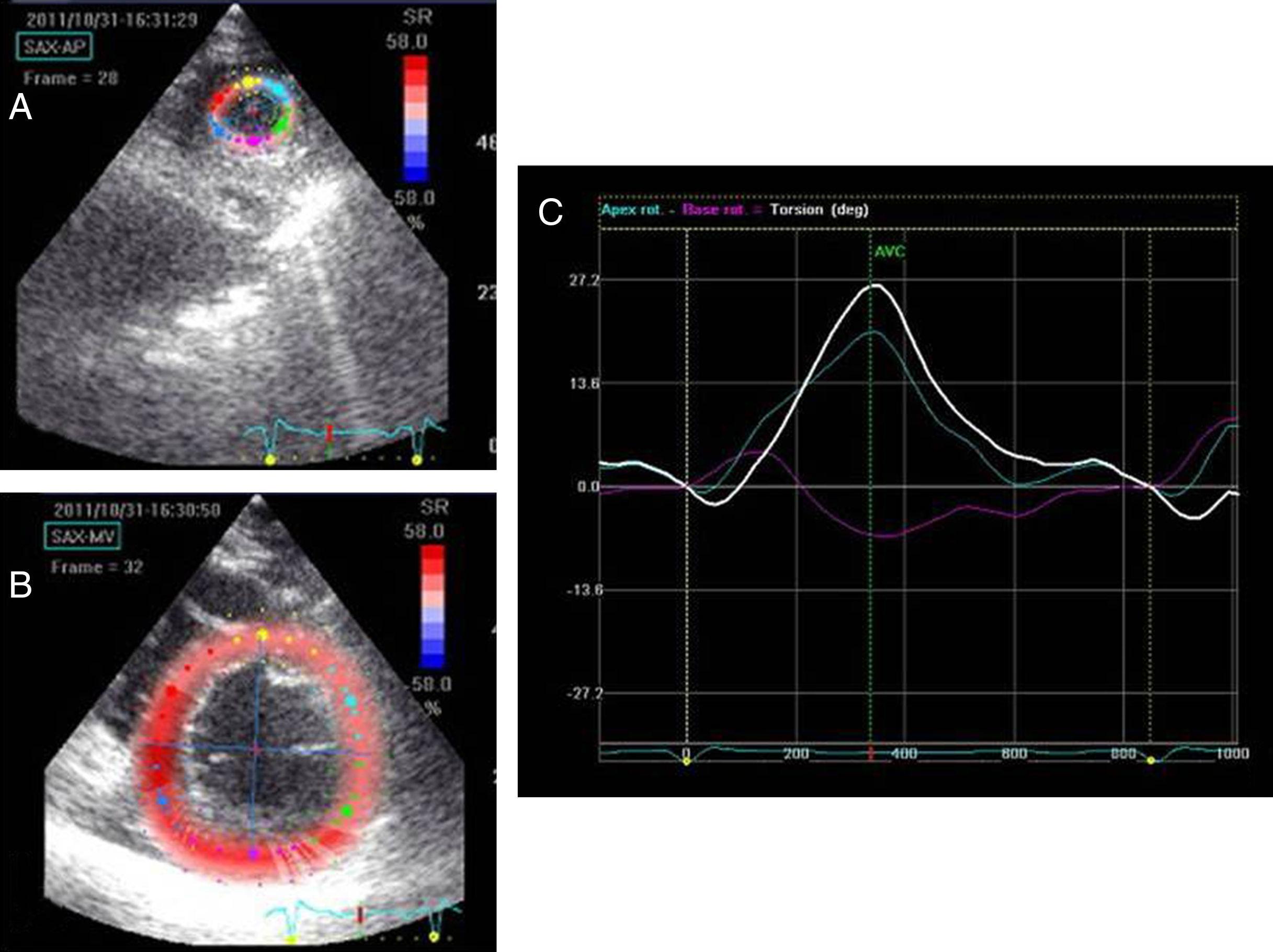 Sex- and Method-Specific Reference Values for Right Ventricular Strain by  2-Dimensional Speckle-Tracking Echocardiography
