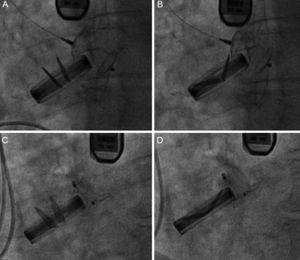 Amplatzer Vascular Plug III 12/5 device implant in aortic position. A: in systole, the device does not interfere with the prosthesis. B: in diastole, the device does interfere with the prosthesis. C: an Amplatzer Duct Occluder 12/10 device implant that does not interfere in systole. D: or in diastole.