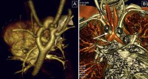 Vascular rings. These were the most common condition in the study. A: three-dimensional volumetric reconstruction, superior-posterior view; complete double aortic arch, with symmetrical arches and isolated origin in supraaortic trunks. B: reconstruction of the airways; reduced tracheal lumen at its passage through the vascular ring (arrow).