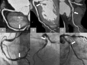 Multidetector computed tomography. Curved multiplanar reconstructions of the right coronary artery (A), left anterior descending artery (B) and circumflex artery (C) showing significant coronary lesions in the 3 vessels confirmed by cardiac catheterization (lower line) in a patient with negative exercise echocardiogram.