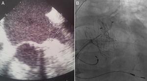 A: Left atrial appendage visualized by endoscopic ultrasound. B: Amplatzer Cardiac Plug release visualized by angiography.