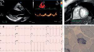A: Case 1 echocardiogram showing a dilated and hypertrophied left ventricle, with decreased tissue Doppler velocities. B: Case 1 electrocardiogram in sinus rhythm, with evidence of left ventricular enlargement. C: Cardiac magnetic resonance imaging of case 2, with increased trabeculation and noncompacted/compacted ratio >2.3. D: ragged red fibers with excess succinate dehydrogenase staining in case 2.