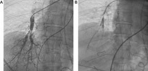 Chronic thromboembolic pulmonary hypertension. A: Membranes in right lower lobe segmental artery. B: Kissing balloon pulmonary angioplasty.