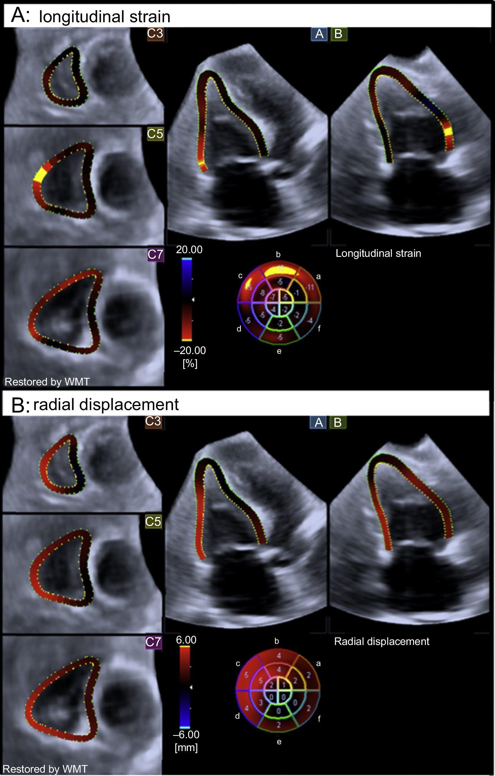 Three and two-dimensional cardiac mechanics by speckle tracking are  predictors of outcomes in chagas heart disease