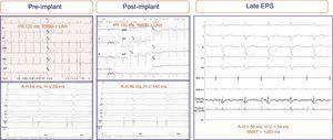 Electrograms and electrocardiograms of a patient with no electrocardiographic abnormalities recorded after prosthesis implantation (bifascicular block was maintained), although significant changes are present in the intracardiac electrogram: H-V interval prolongation (from 58 ms to 140ms). Repeat electrophysiologic study 7 days after implantation showed full normalization of the intracardiac intervals. ADA, anterior descending artery; EPS, electrophysiologic study; LAH, left atrial hemiblock; RBBB, right bundle branch block-bundle of His; RV; right ventricle; SNRT, sinus node recovery time.