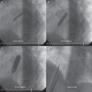 A-C: Atrial septostomy with progressive balloon dilatation. D: Stent fenestration of the atrial septum. IAS, interatrial septum.