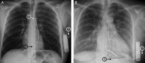 Chest X-rays showing automatic subcutaneous implantable cardioverter-defibrillators implanted by the 3-incision method (A) and the 2-incision method (B).