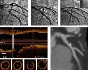 A: baseline angiography; B: implantation of 3.5 × 18-mm bioresorbable vascular scaffold in in anterior descending artery with occlusion of diagonal branch (arrows); C: final angiographic image after postdilatation of diagonal branch with a 2.5 × 15-mm balloon; D: final optical coherence tomography image. In the upper portion, longitudinal reconstruction and, in the lower portion, axial scans at the proximal level (1), at the origin of the side branch (2), with correct apposition in the segment opposite the side branch origin, posterior to the origin of the diagonal branch (3), and distal reference (4); E: computed tomography angiography at 6 months of follow-up.