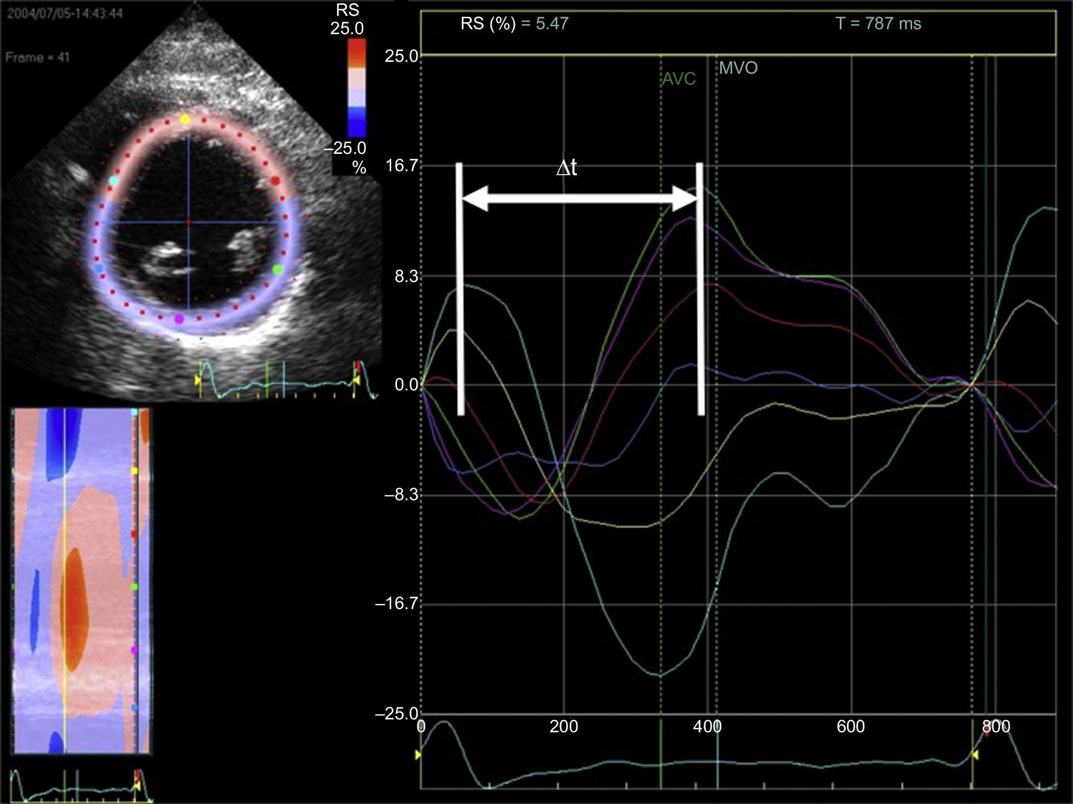 Speckle-tracking strain echocardiography: Any place in routine