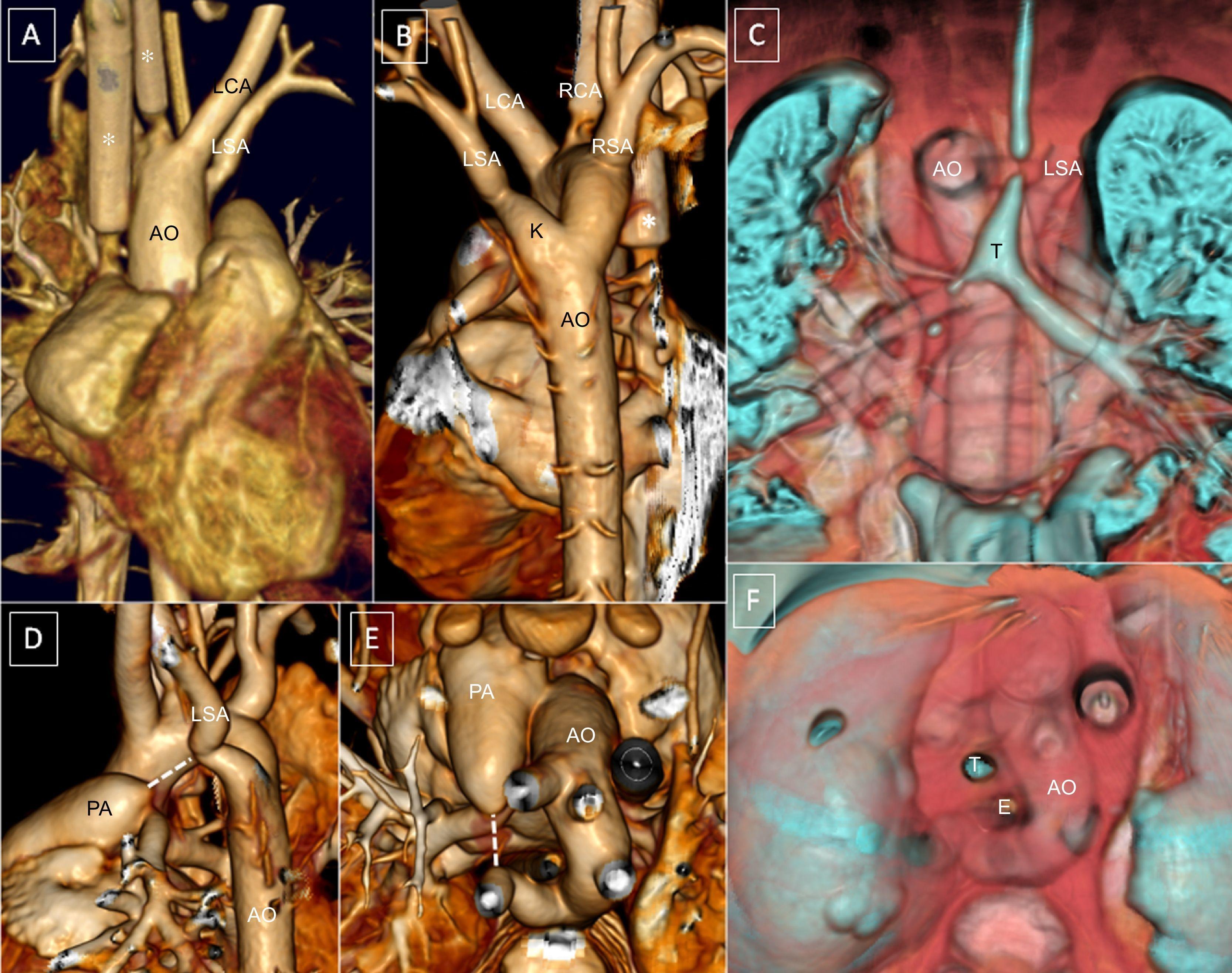 A Case of Rubinstein-Taybi Syndrome with Tetralogy of Fallot