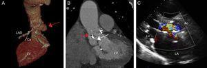 A: Computed tomography volume rendering; the red arrow indicates the fistula with origin in the noncoronary valve and extending along the posterior part of the aortic annulus to the left coronary valve. B: Computed tomography, coronal view; the red arrow indicates the connection with the ascending aorta; the white arrow indicates connection with the left ventricular outflow tract. C: Transthoracic echocardiogram, long parasternal view, in which the regurgitation jet can be observed occupying the entire left ventricular outflow tract and leading to severe aortic insufficiency. Ao, aorta; Cx, circumflex artery; LA, left atrium; LAD, left anterior descending artery; LV, left ventricle.