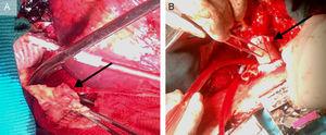 A: operative findings: the Dacron patch, a segment of the aortic wall at the level of the suture line dehiscence and periaortic inflammatory tissue (arrow) are evident. B: the surgical repair: Dacron tube graft descending aorta reconstruction (arrow), with suture line being reinforced by Teflon strips. The site of the aortic arch cannulation is also quite evident.