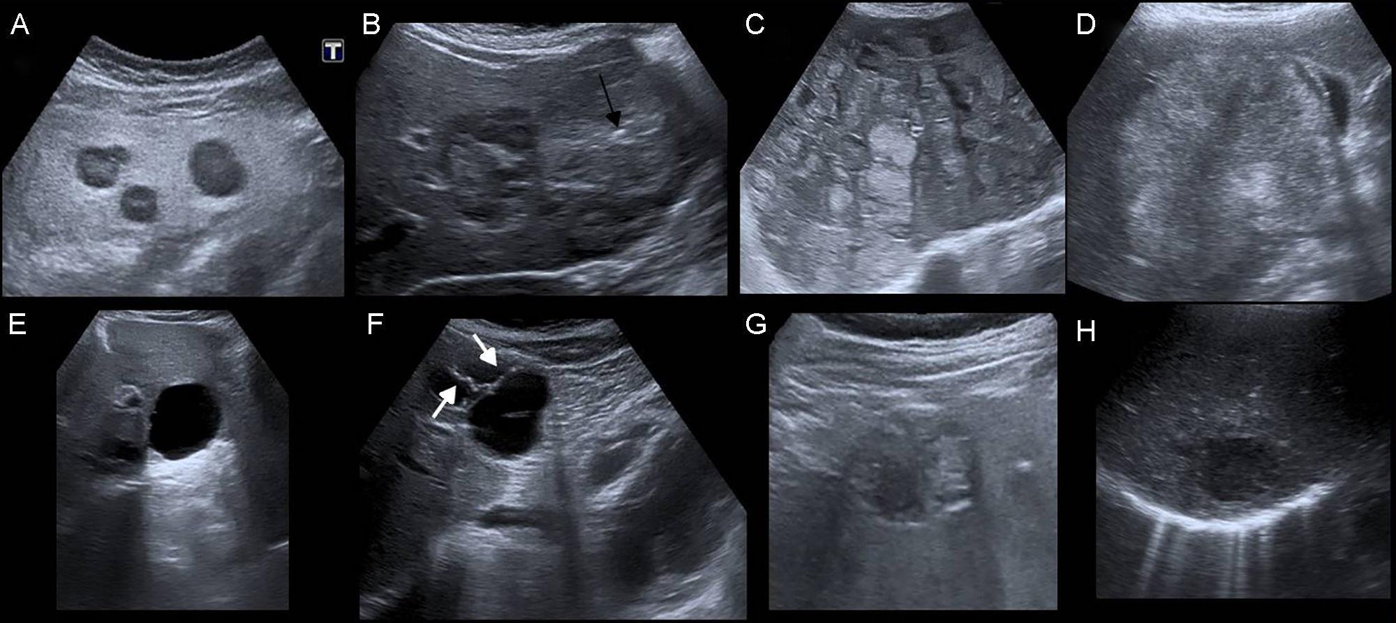 normal vs fatty liver ultrasound