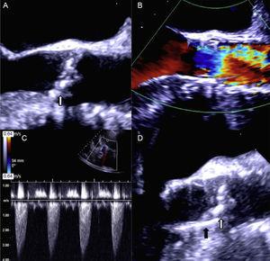 A, Echocardiographic images depicting preimplantation. B, Immediate postimplantation flow through prosthesis. C, Left ventricle-aorta gradient following prosthesis migration. D, Two-dimensional image of the prosthesis after migration. White arrow pointing toward native valve calcium. Black arrow pointing toward prosthesis.
