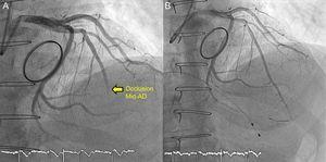 Coronary angiography. A: acute occlusion in the midleft anterior descending artery. B: anterior descending artery after thrombectomy. AD, anterior descending.