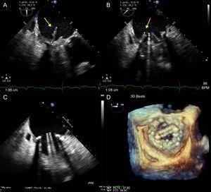 Transesophageal echocardiography. A and B: endocarditic vegetation on mitral prosthetic valve. C: postsurgical transesophageal echocardiography, 90° view; the mitral prosthetic valve shows no signs of infective endocarditis. D: 3-dimensional echocardiography using zoom (en face).