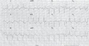 Presenting electrocardiogram from a patient with an ST-segment elevation myocardial infarction equivalent; the culprit artery was the left circunflex and was treated by primary percutaneous coronary syndrome. Smith rules are negative.