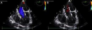 Transesophageal echocardiogram showing absence of stenosis (A) and regurgitation (B) with the implanted valve.