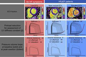 Overview of the results of the Left Ventricular Stiffness vs Fibrosis Quantification by T1 mapping in Heart Failure With Preserved Ejection Fraction (STIFFMAP) trial.12 While HFpEF patients demonstrated overall higher ECV, an elevated left ventricular stiffness constant, prolonged relaxation and a pathological rise of the end-diastolic pressure volume relations under exercise were found. After stratification according to the ECV median, in the HFpEF group with near normal ECV values, this was found to be caused predominantly by an elevated arterial stiffness, a marked hypertensive reaction to exercise and prolonged active relaxation. In the HFpEF group with the highest ECV, pronounced ventricular stiffening predominantly caused the pathological hemodynamic exercise response. ECV, extracellular volume; HF, heart failure; HFpEF, heart failure with preserved ejection fraction; LV, left ventricular.