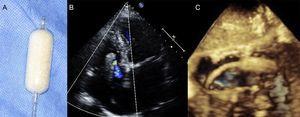 Coaptation devices: FORMA. A: Spacer. B: transthoracic echocardiography 4-chamber-view after device implantation. C: three-dimensional transthoracic echocardiography image of FORMA device.