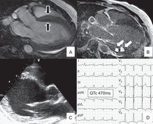 A and B: Patient number 2 (Table). A: Magnetic resonance imaging showing severe concentric hypertrophy (septum, 18mm; black arrows). B: LGE sequence showing foci of LGE (white arrows) in inferior segments. C: Echocardiographic results for patient number 1 (Table). Severely dilated left ventricle (LVIDd, 74mm). Diastolic sphericity index, 70% (normal, 29% ± 6%). D: Prolonged QTc (470ms) (patient number 2, Table). LGE, late gadolinium enhancement; LVIDd: left ventricular internal dimension at end-diastole; QTc, corrected QT.