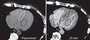 Two computed tomography images with optimized window settings to highlight contrast between myocardial and blood attenuation are exhibited. In all images, the region of interest is positioned in the septum (white circle), and in blood pool (black circle). Precontrast acquisition image and acquisition 25minutes after initiation of pump infusion are shown.