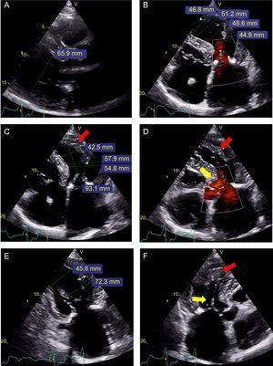 Transthoracic echocardiogram before implantation. A: Parasternal long axis view; left ventricular end-diastolic diameter (65.9 mm). B: Apical 4-chamber view in systole; various diameters from the base (44.9 mm) to the apex (46.8 mm). C: Apical 4-chamber view in diastole; various diameters from the base (54.8 mm) to the apex (42.5 mm); trabeculation in the lateral apical region (red arrow), not seen in systole. D: Apical 4-chamber view in systole and in color; trabeculation in the lateral apical region (red arrow), with better definition of the separation with the lateral wall; the yellow arrow shows acceleration in the outflow tract. E: Apical 2-chamber view in end-diastole; end-diastolic diameter of the basal (72.3 mm) and middle (45.6 mm) left ventricle. F: Apical 3-chamber view in systole; anterior systolic movement (yellow arrow) and apical trabeculation (red arrow) are observed.